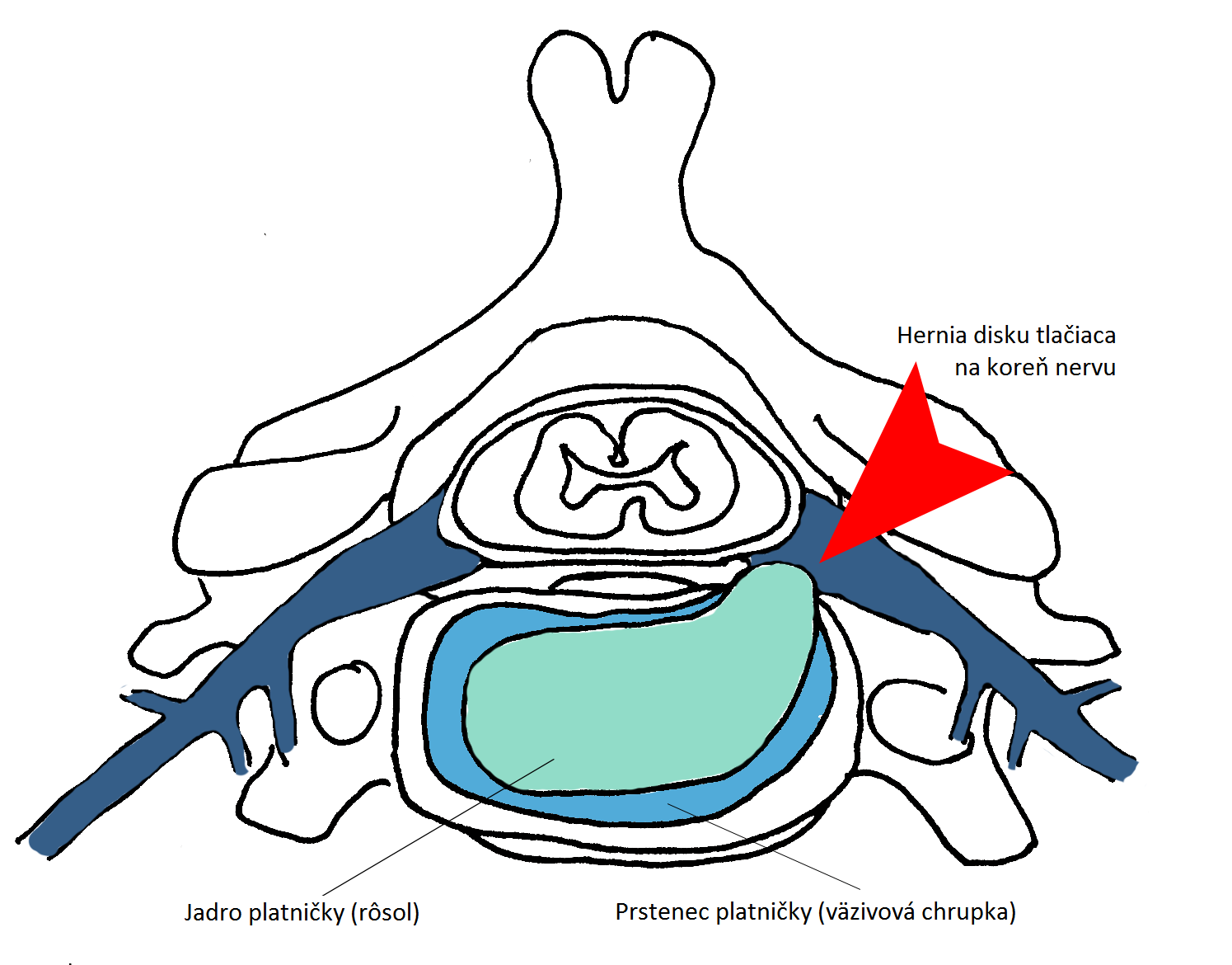 Platnika HERNIA
